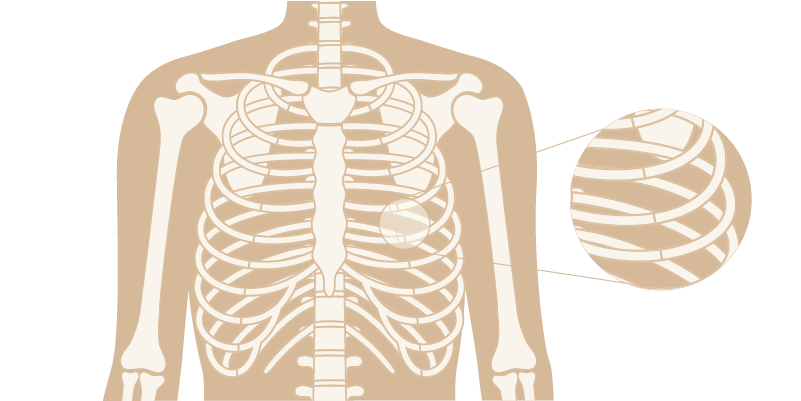 the causes and symtoms of intercostal musle strain