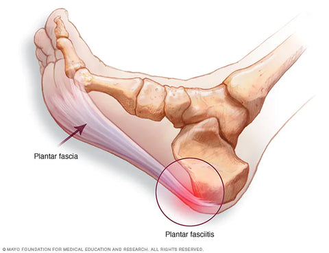 PLANTAR FASCIITIS  Plantar fasciitis is the irritation of the tissue supporting the arch of the foot. The pain is from inflammation in the fascia (a thick fibrous material) that covers the bottom (plantar) of the foot, this may also cause heel pain.