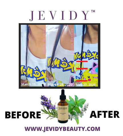 GROWTH RESULTS WITH JEVIDY SCALP REVITALIZATION DROPS