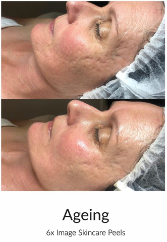 acne scarring and anti ageing facials in oak flats