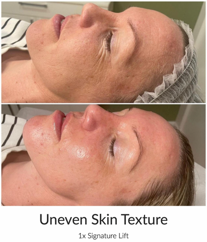 anti ageing facials for wrinkles and fine lines