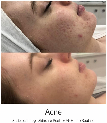 Acne Facials in shellharbour and oak flats. Before and after photos