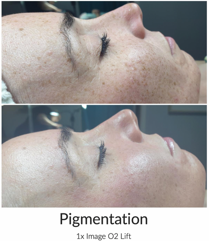 oxygen facials in shellharbour for pigmentation and scarring