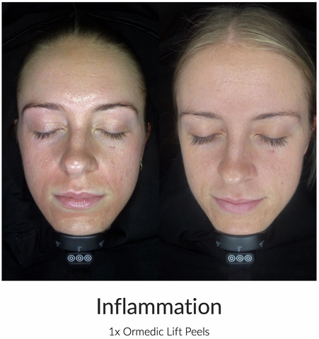 facial for inflammation and redness, sensitive skin, oak flats, shellharbour, albion park