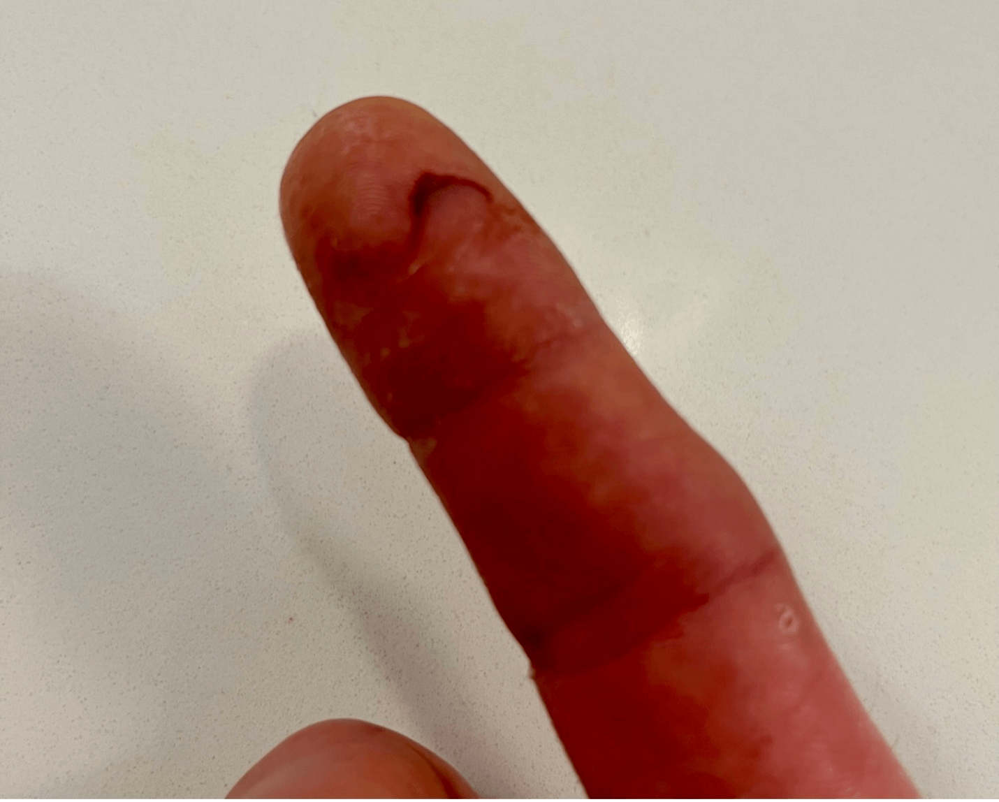 12 Hours after the Accident: the wound is sealed by the coagulated blood