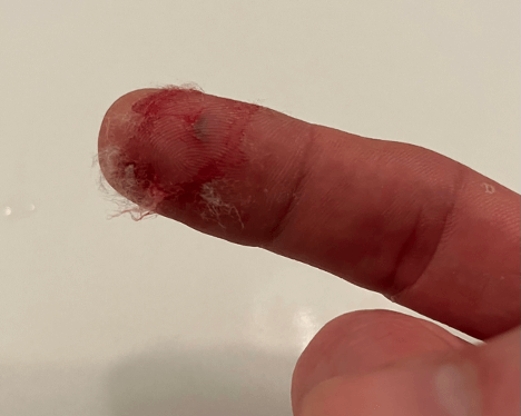 2 Hours after the Accident: Before I cleaned up the finger but you can see the chitosan fibers and that the bleeding has stopped