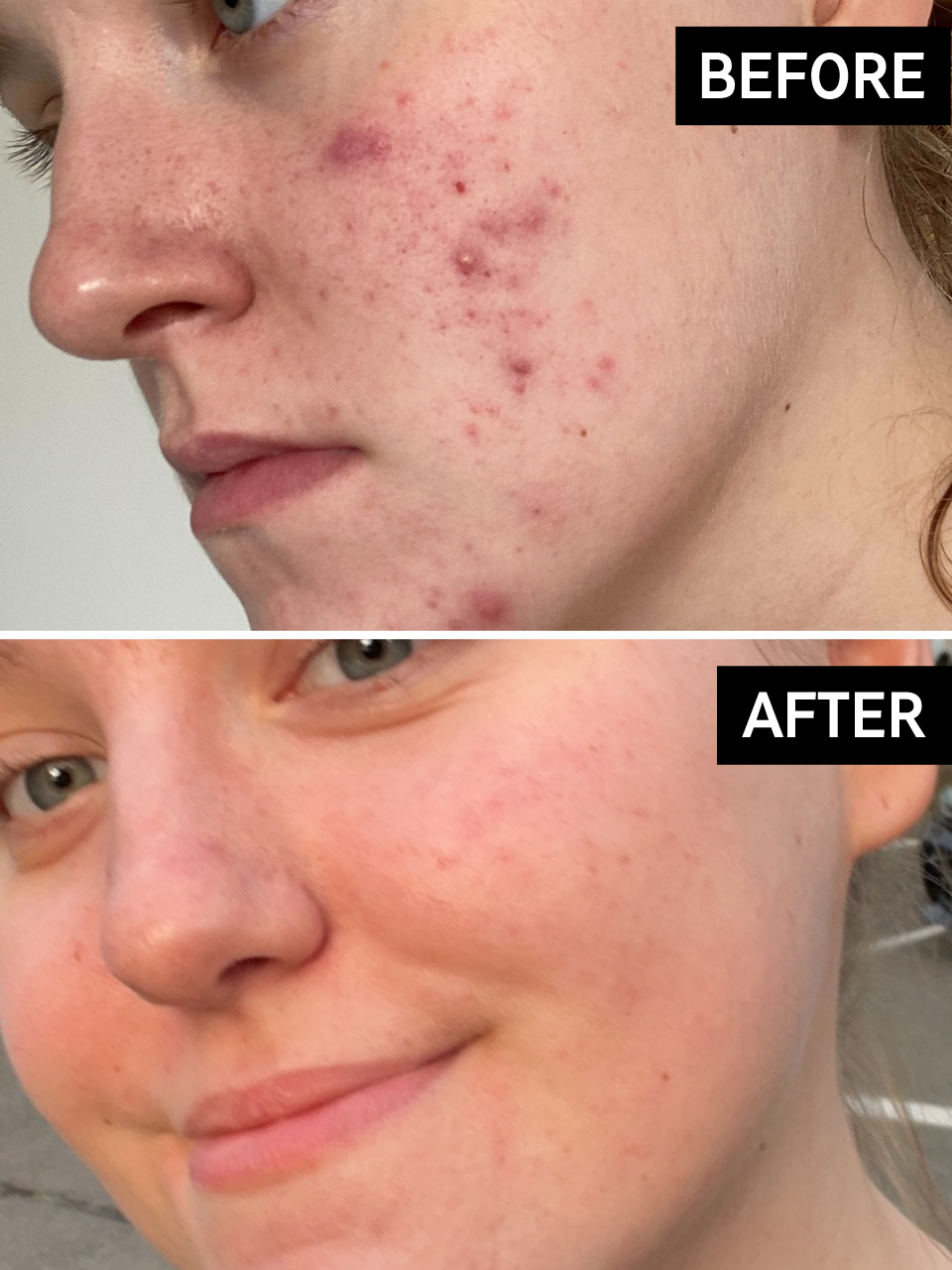 Hyperpigmentation Results Before & After With The INKEY List