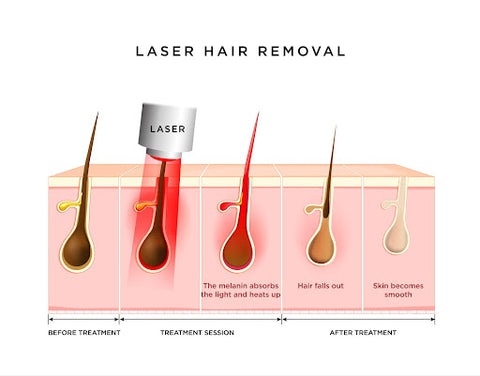 Laser Hair Removal How It Works