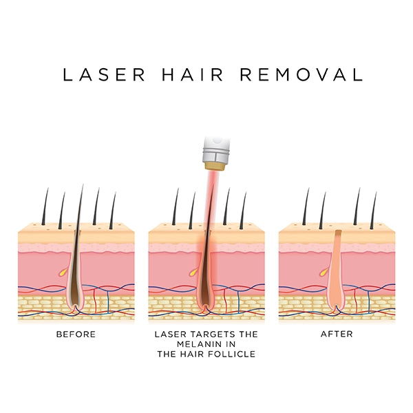 faq laser hair removal