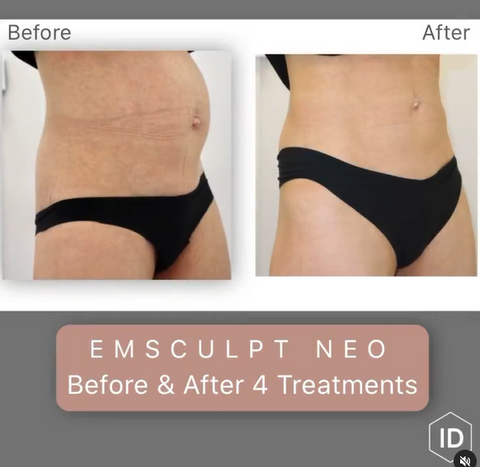 EMSCULPT NEO Before/After – Institute of Dermatologists