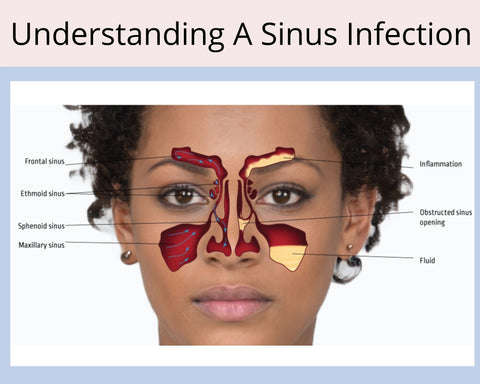 Understanding A Sinus Infection