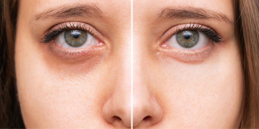 Gros plan d'yeux féminins présentant des cernes sous les yeux avant et après avoir utilisé de l'eau de bleuet