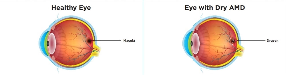 illustration montrant une anatomie d’yeux sains et d’yeux atteints de dégénérescence maculaire sèche liée à l’âge.