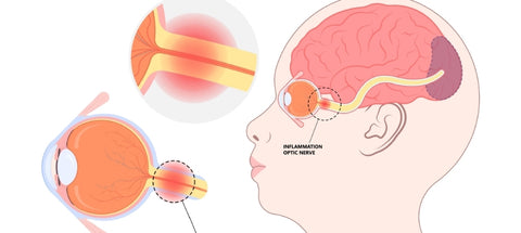 photo montrant une névrite optique