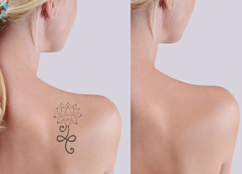 Laser Technology is Making Tattoo Removal Easier Than Ever  Innovation  Smithsonian Magazine