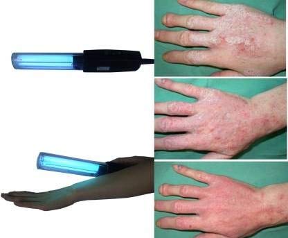 uv rays psoriasis