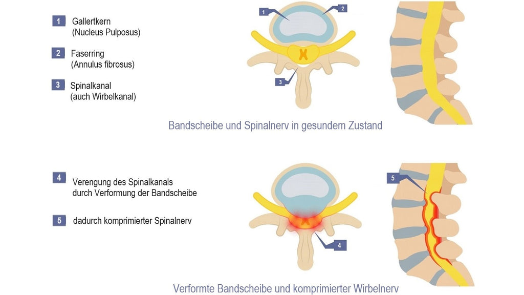 Eine Einengung des Spinalnerves kann zu Beschwerden und Schmerzen führen
