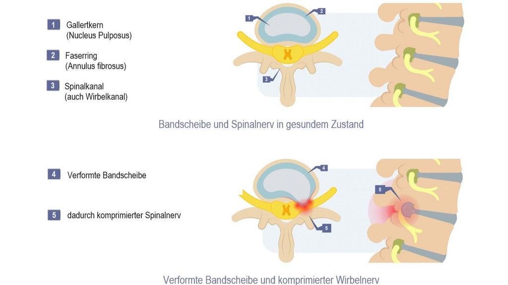 Wenn die Bandscheiben zwischen den Wirbelkörpern sich verformen kann es zu erkrankungen der wirbelsäule kommen