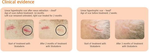 Strataderm Clinical Evidence