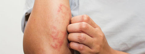 What’s the Difference Between Eczema and Psoriasis?