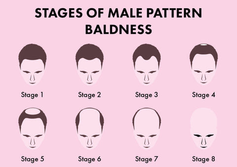 Stages of Male Pattern Baldness