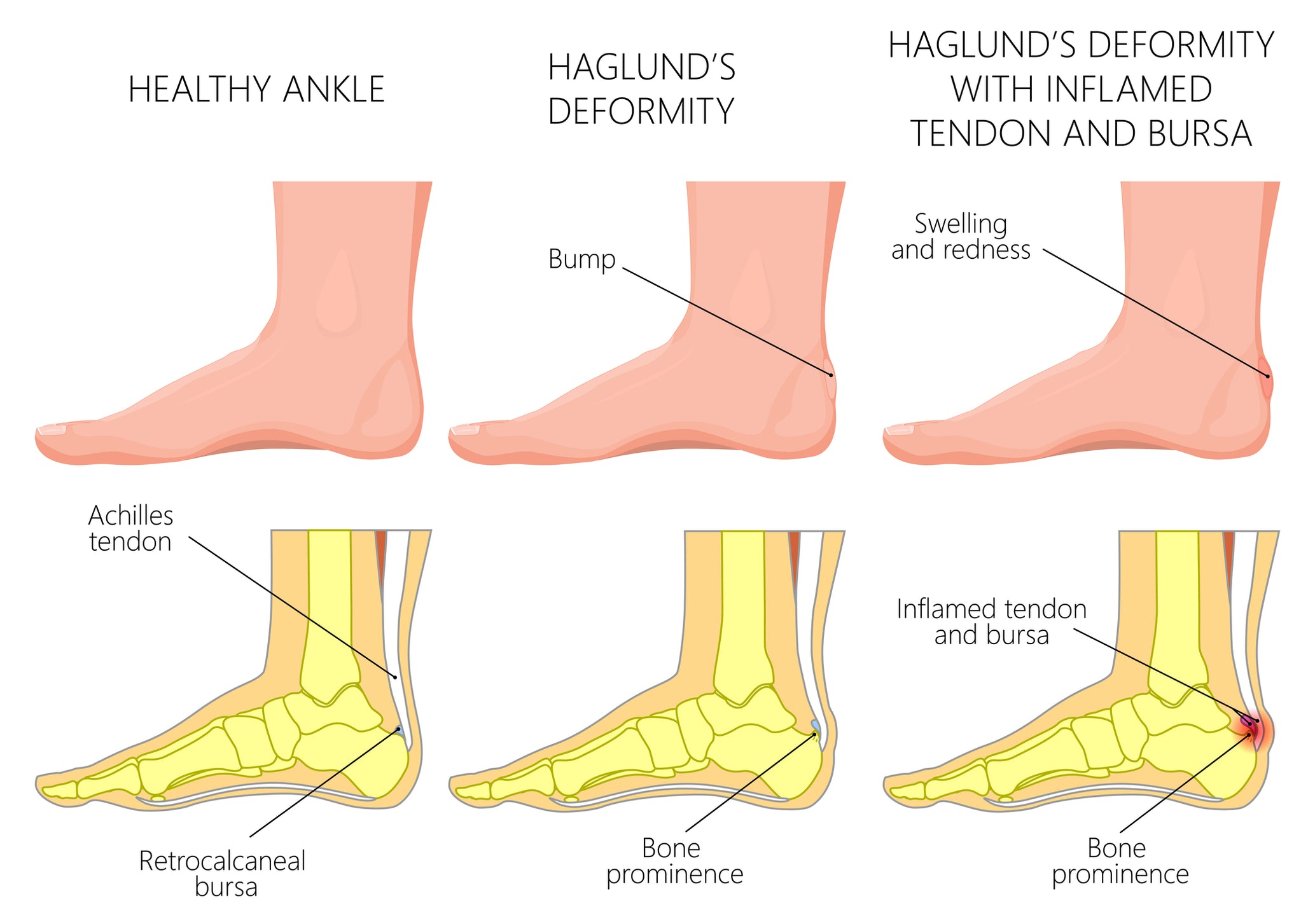 Best Shoes For Haglund's Deformity — Wide Shoes