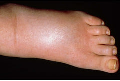 Causes of Oedema