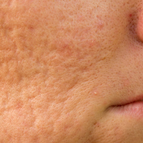 popping pimples can cause acne scaring