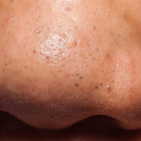 blackheads on nose