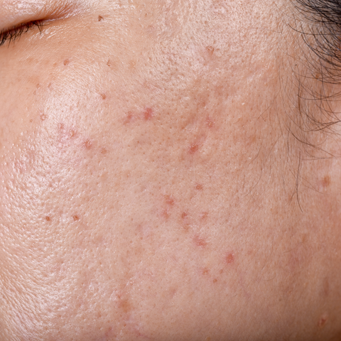 treatment of adult acne