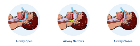 OSA- Airway