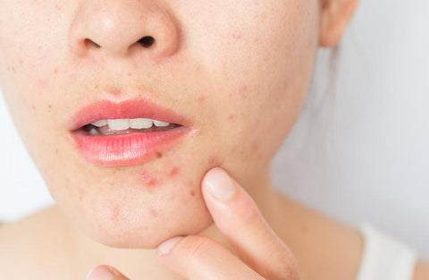 https://www.healthgrades.com/right-care/skin-hair-and-nails/boil-vs-pimple-how-to-tell-the-difference