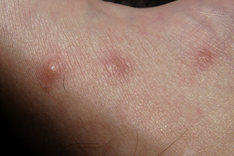 lichen sclerosus on legs