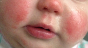 Red burning skin: a classic symptom of eczema