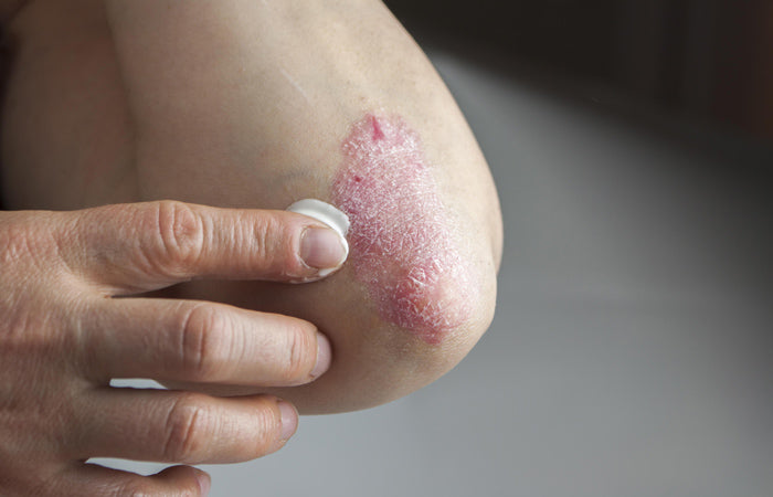 applying topical steroid on elbow eczema