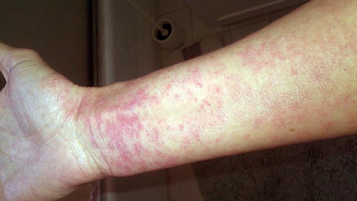 Burning and stinging sensation caused by TSWS