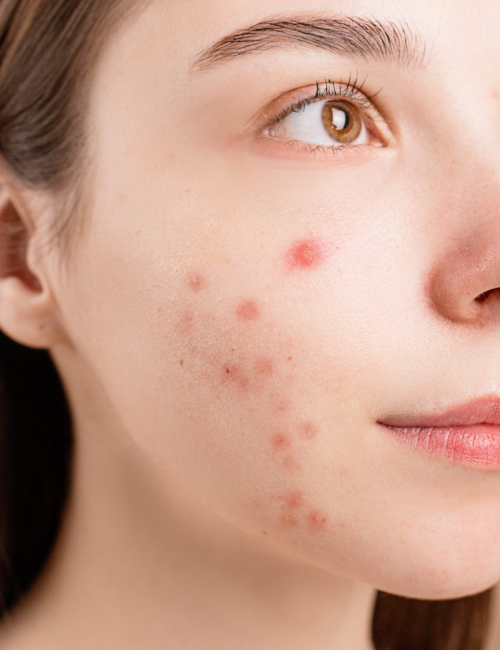 close-up of a woman with acne