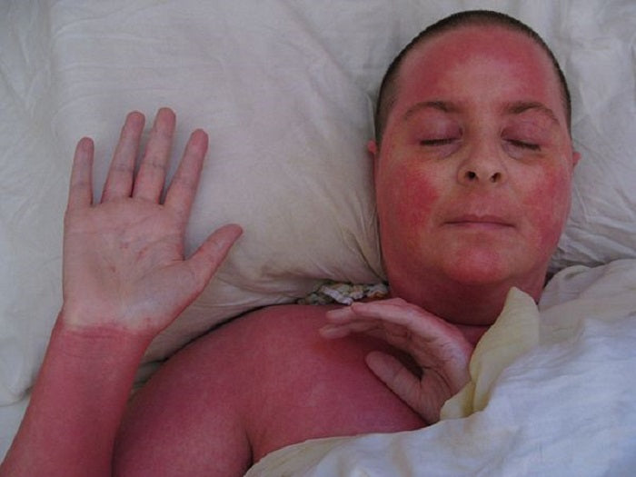 woman with red skin syndrome