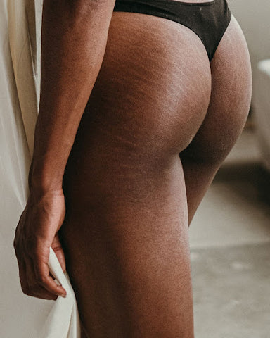 Woman with stretch marks on buttocks and legs