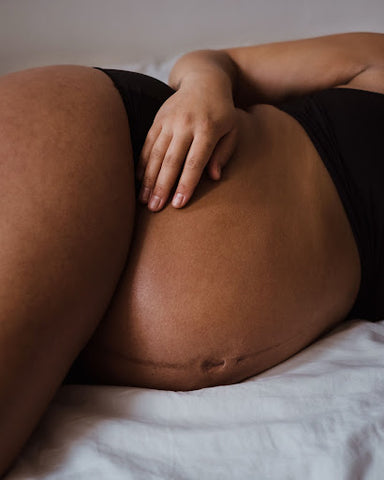 Woman laying on bed with long stretch mark down belly