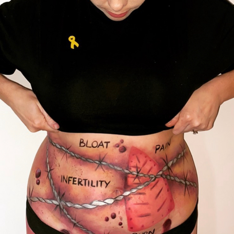 Endometriosis 