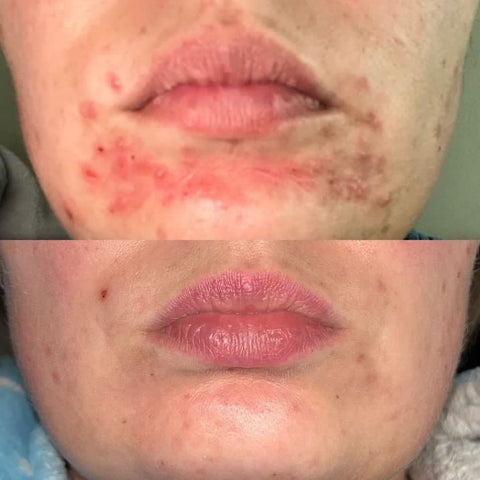 hemp seed oil before and after acne fighting