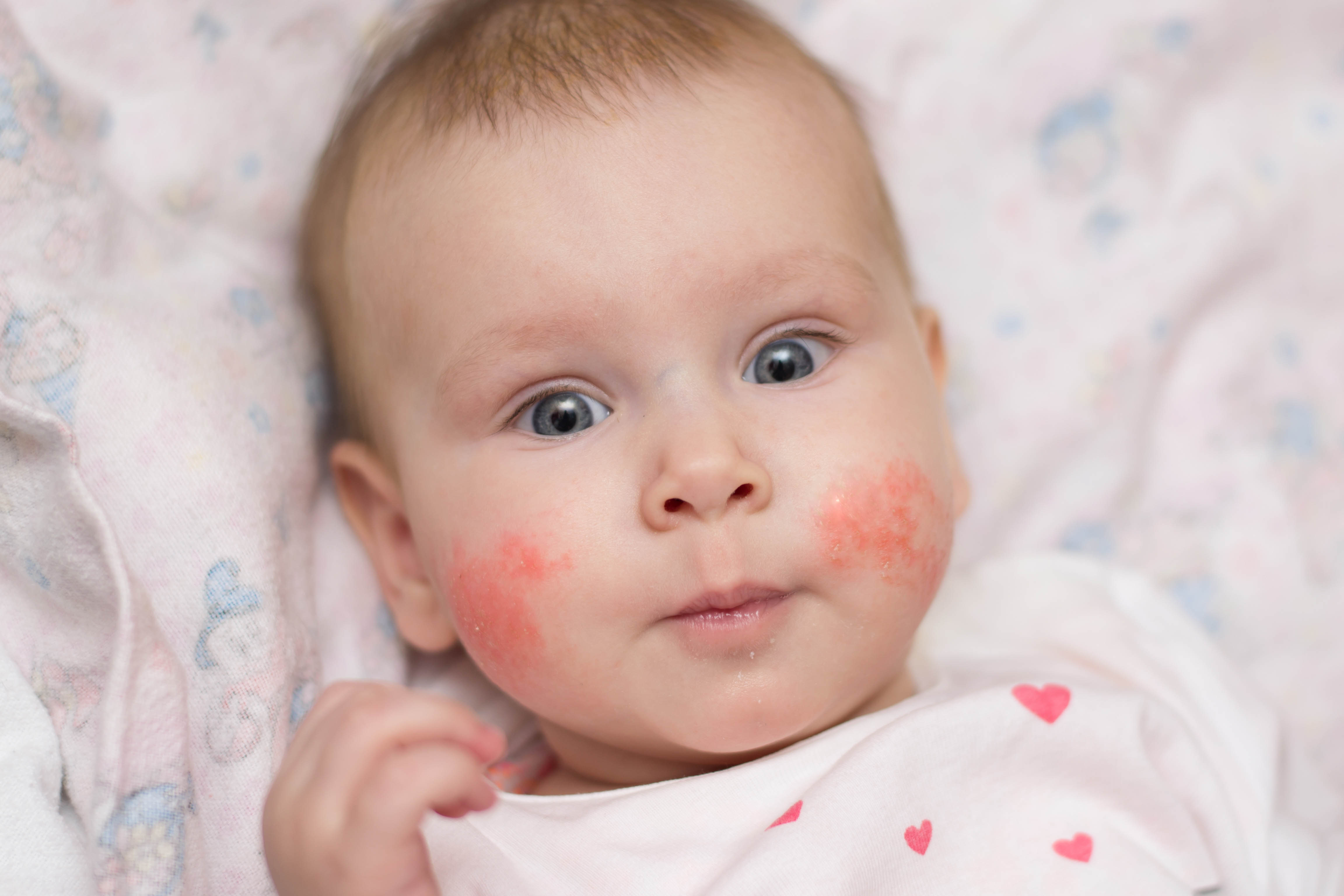 Baby with eczema, merino lanolin skincare