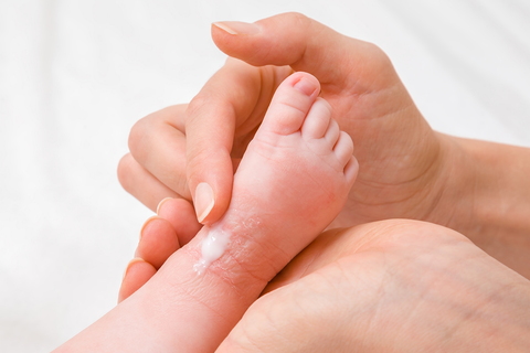 Baby with eczema being treated with merino lanolin cream