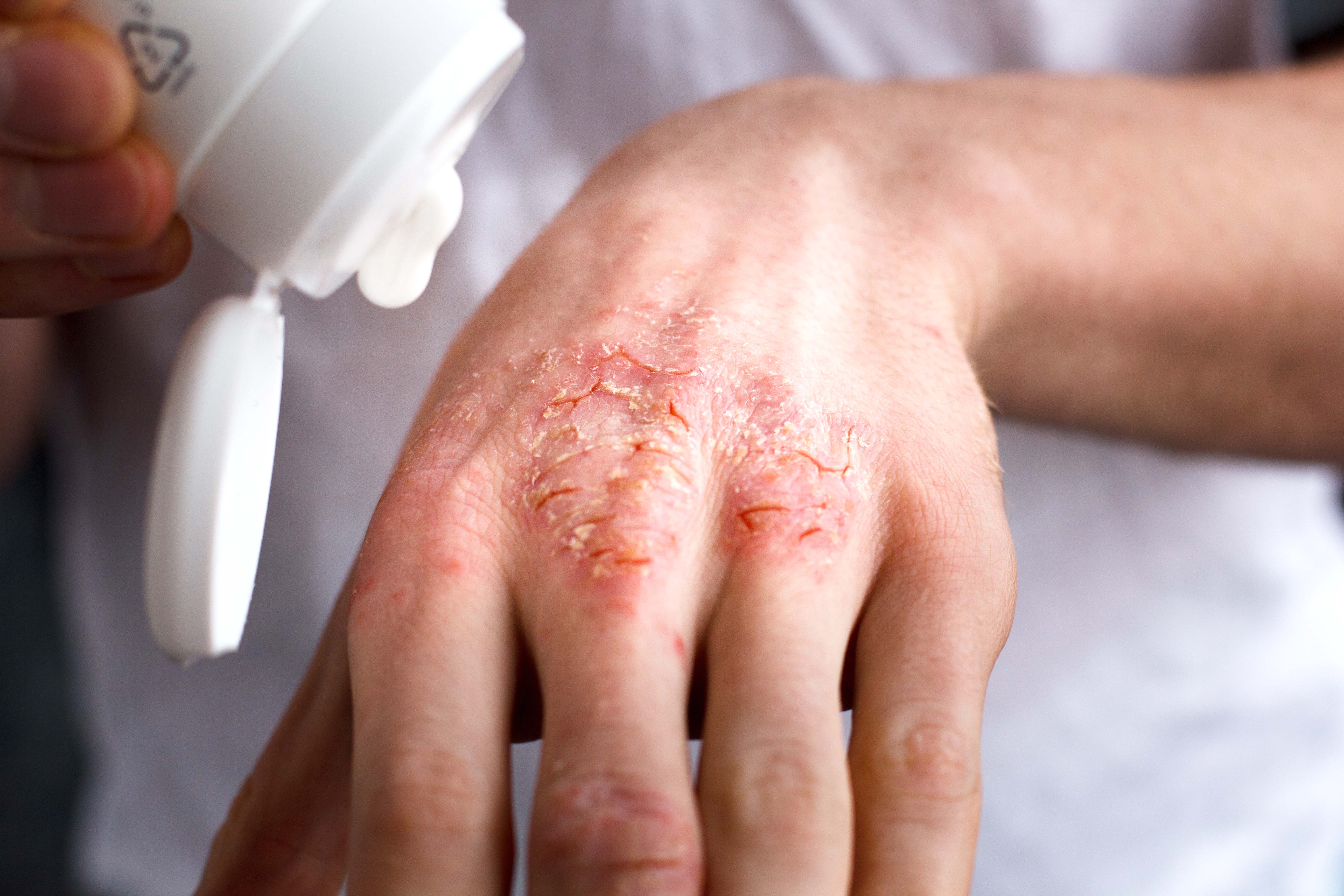 Merino Skin care, Man with Psoriasis using merino lanolin hand cream.