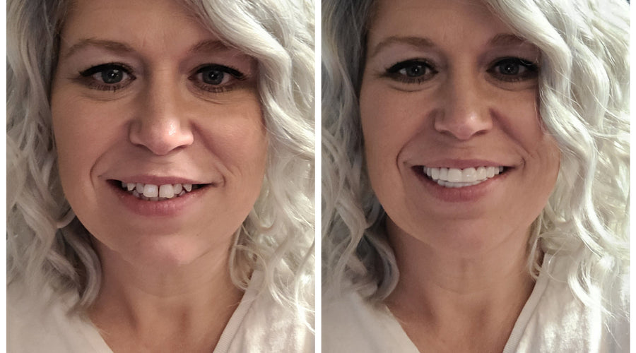 pop on veneers cost