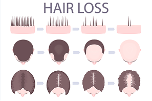 Image that shows what hair loss looks like at the scalp level