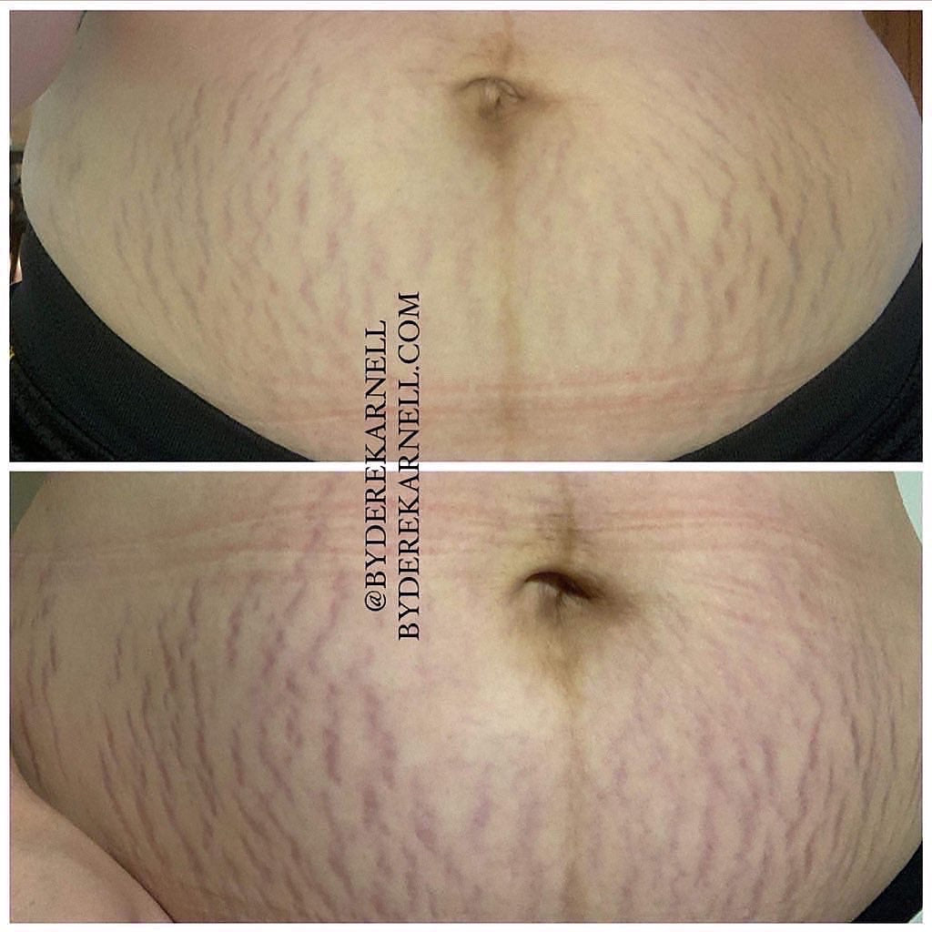 Stretch Mark Cellulite Trio Urban Aesthetics By Derek Arnell