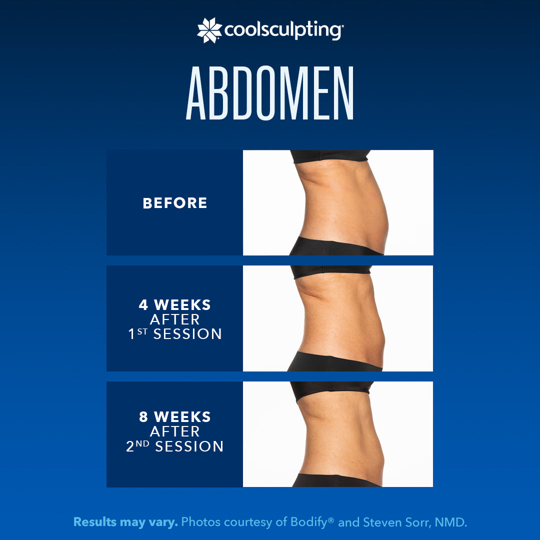 coolsculpting abdomen results