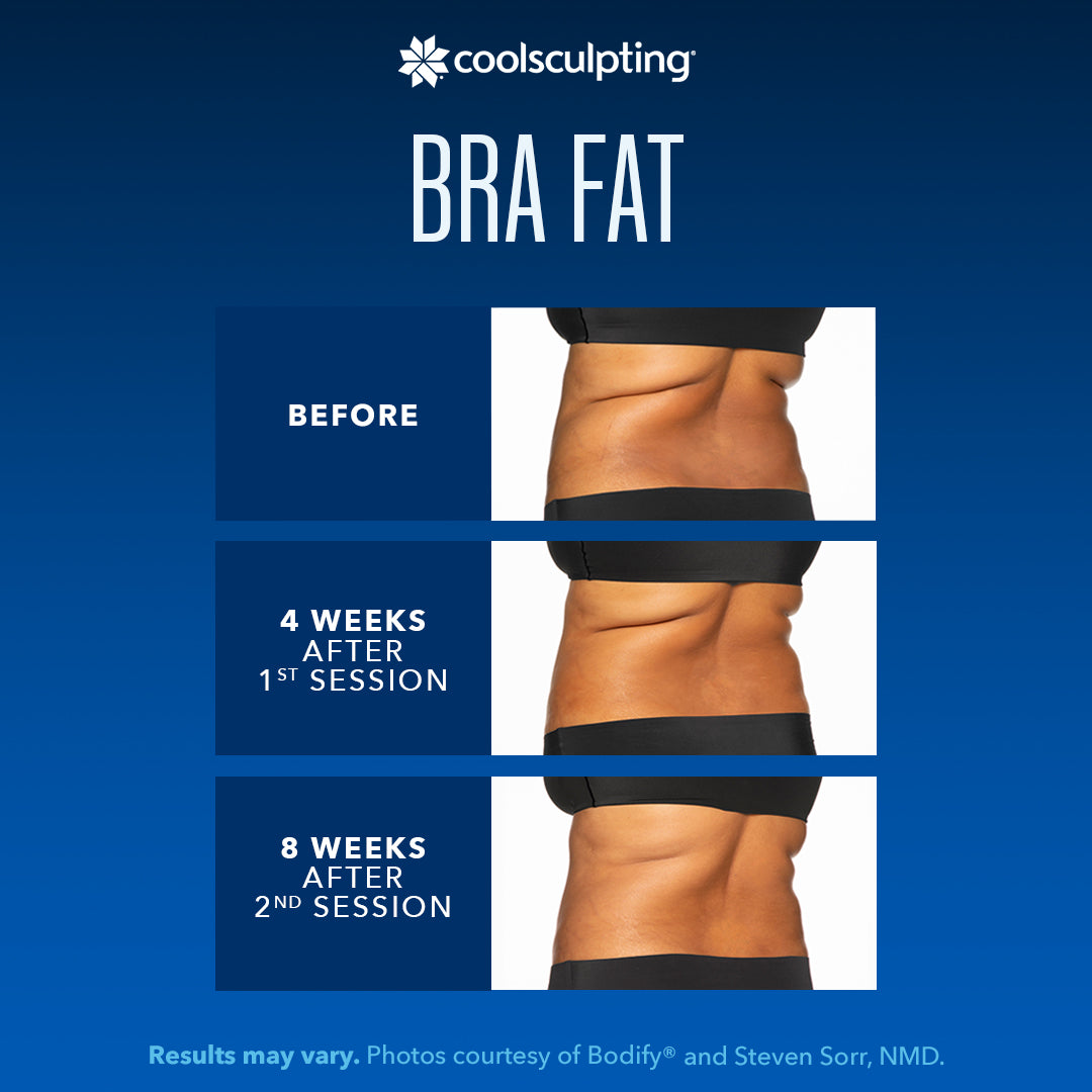 coolsculpting bra fat results